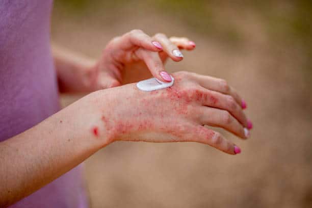 what is eczema
